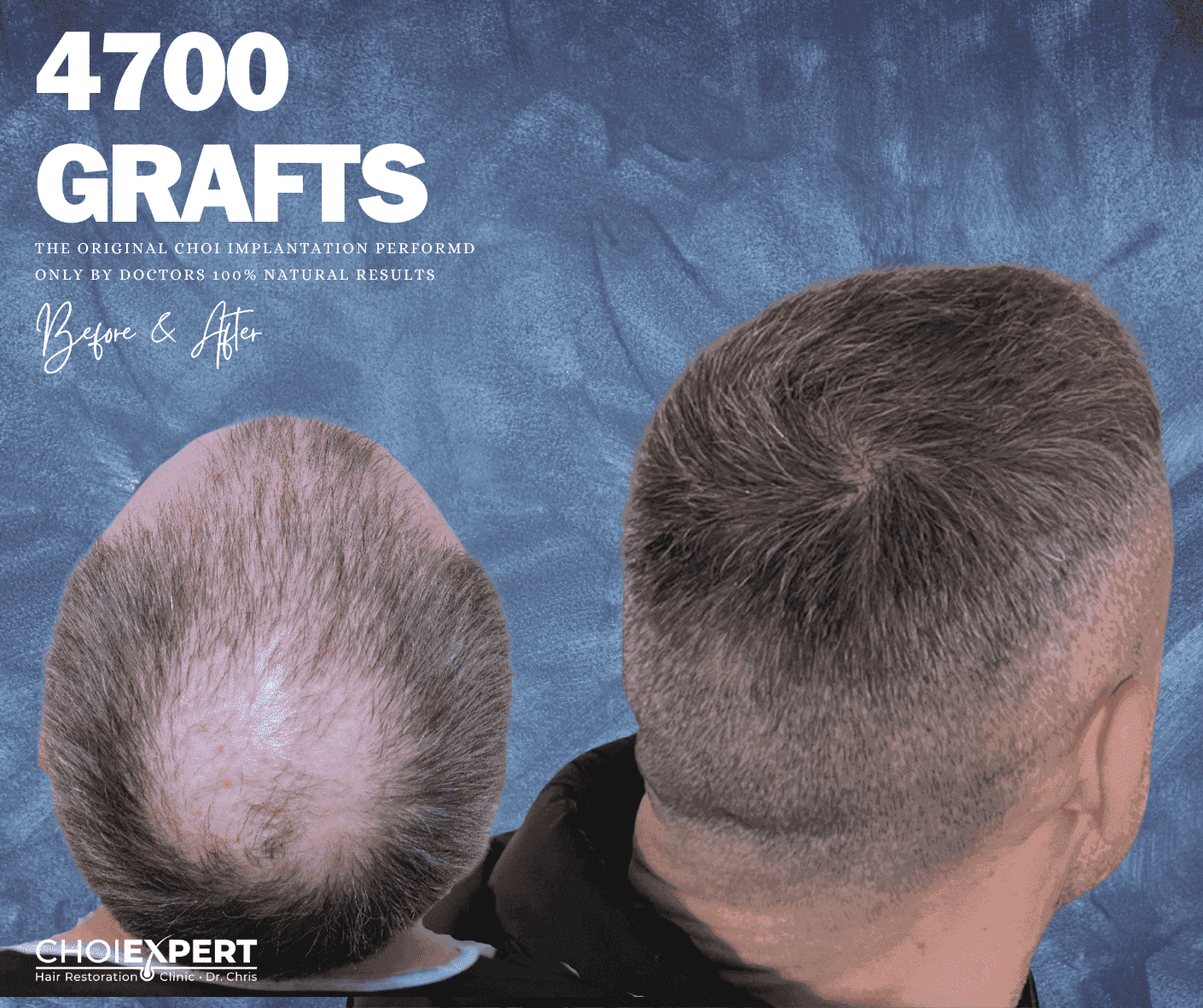 ChoiExpert hair transplant result 1 — before and after