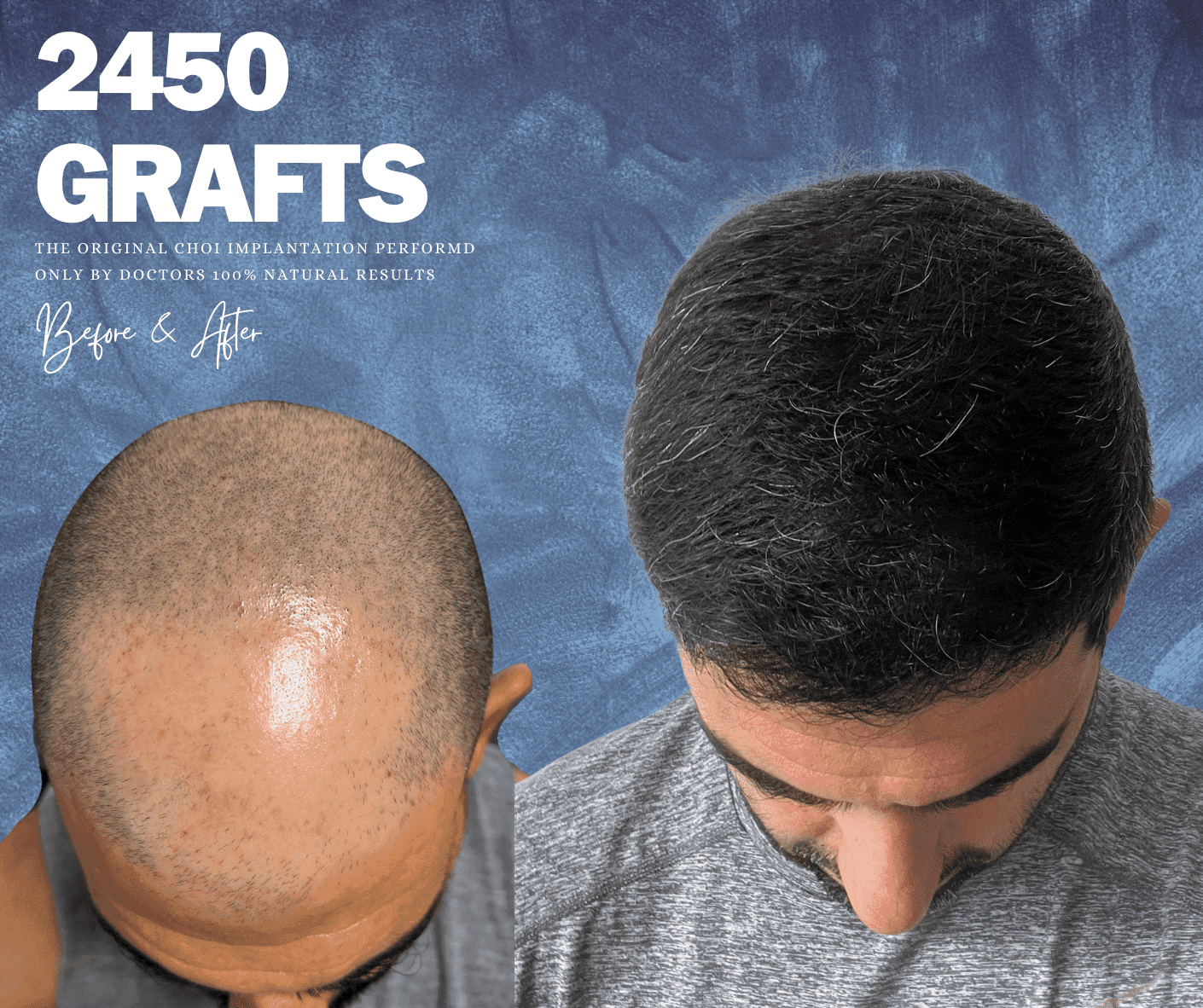 ChoiExpert hair transplant result 2 — before and after