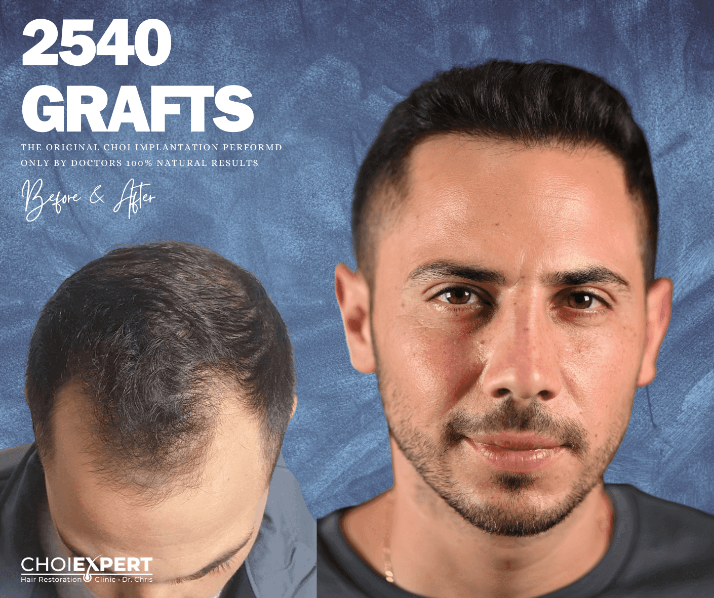 ChoiExpert hair transplant result 3 — before and after